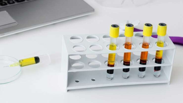 PRP (Platelet Rich Plasma)